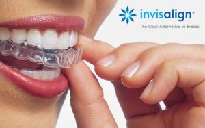 Invisalign - Edgware - Stage Lane Dental Centre