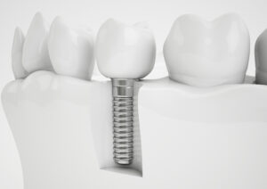Diagram of a dental implant