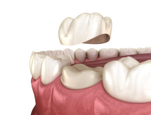 dental crown diagram