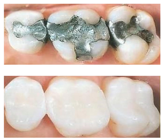 Before and after photo of silver fillings and white fillings