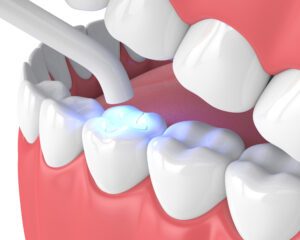 Diagram of a white tooth filling