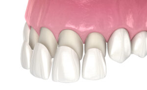 dental veneers in edgware - Diagram of Dental Veneers
