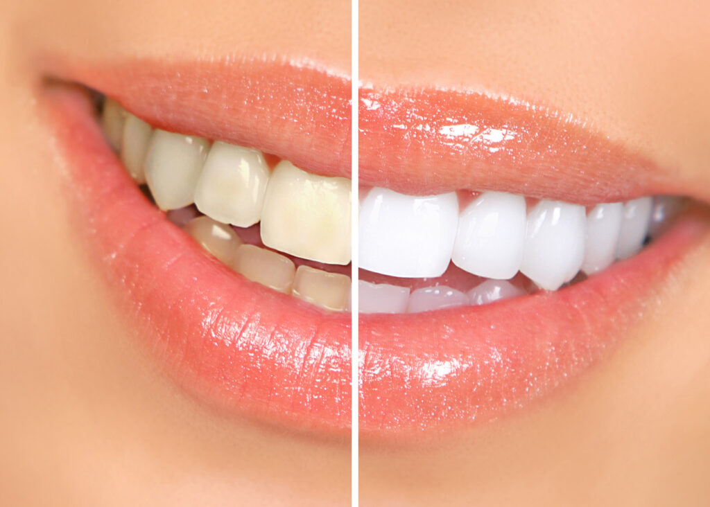 Teeth whitening Edgware - Photo of before and after teeth whitening