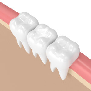Photo graphic of a white tooth filling