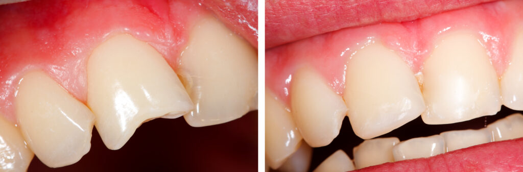 Before and after photo of composite bonding at Stag Lane Dental