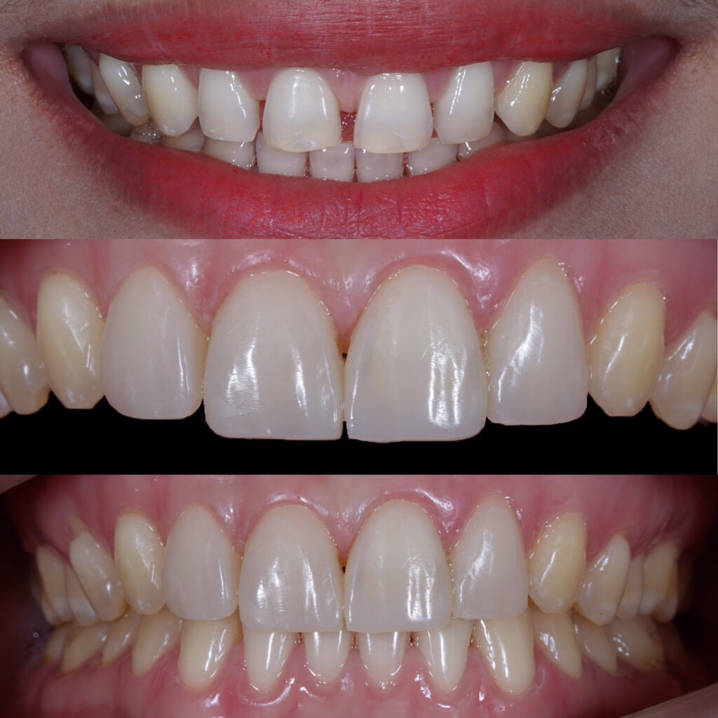 Before and after photo of composite bonding at Stag Lane Dental