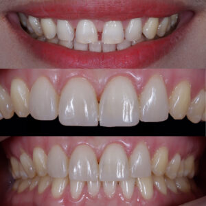 Before and after photo of composite bonding at Stag Lane Dental