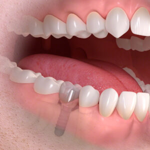 Dental Implants Edgware - Diagram of a dental implant