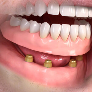 Diagram of a removable denture with attachment