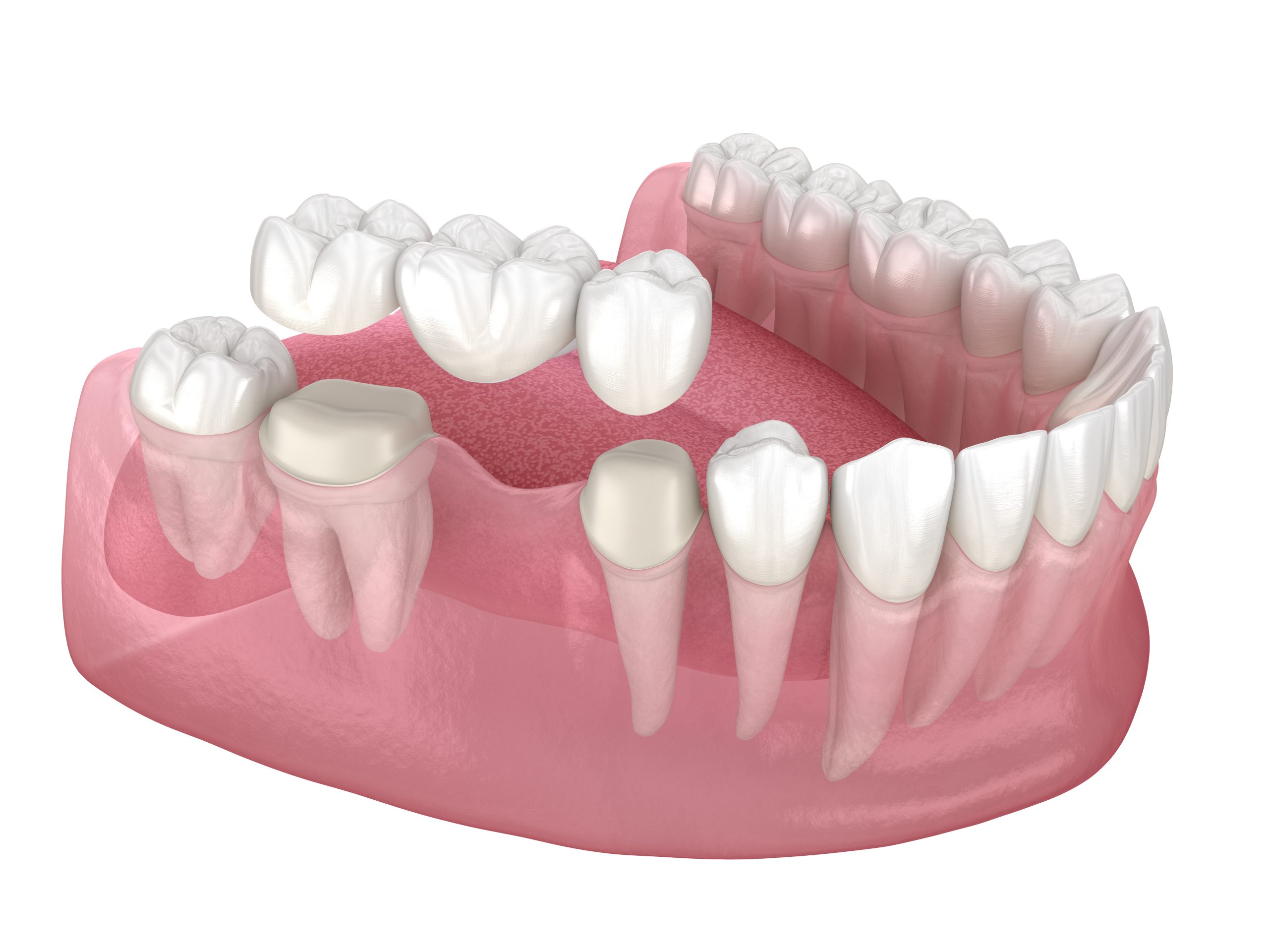 Dental,Bridge,Of,3,Teeth,Over,Molar,And,Premolar.,Medically