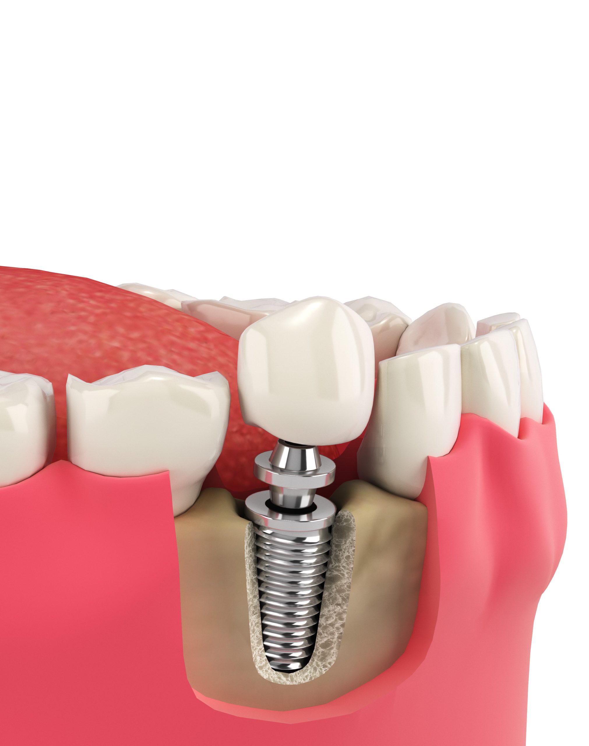 single-tooth-implant-02