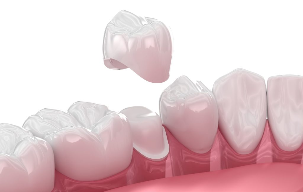 Dental,Crown,Placement,Over,Tooth.,3d,Illustration