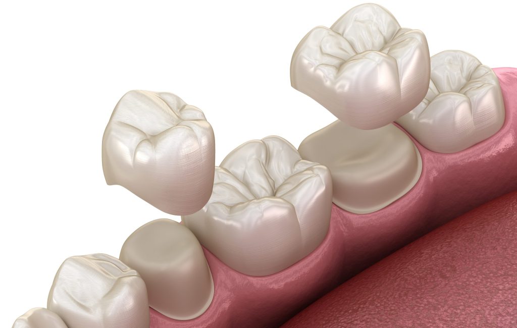 Porcelain,Crowns,Placement,Over,Premolar,And,Molar,Teeth.,.,Medically