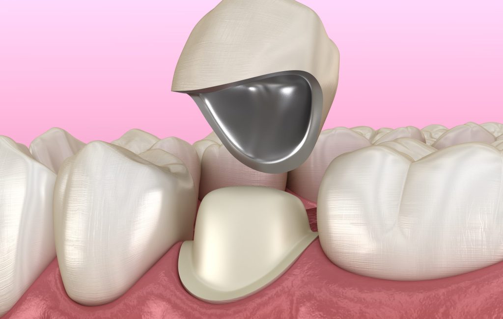 Preparated,Premolar,Tooth,And,Dental,Metal-ceramic,Crown.,Medically,Accurate,3d